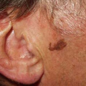 Laser Behandlung Praxis Dr. Kai Rezai