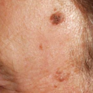 Laser Behandlung Praxis Dr. Kai Rezai