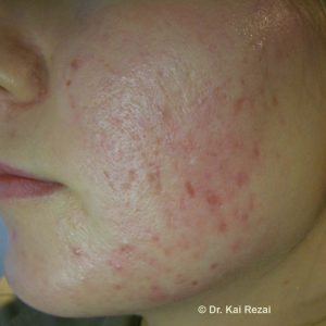 Micro Needling vorher