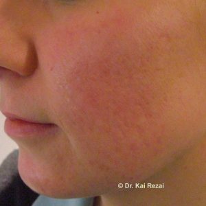 Micro Needling nachher