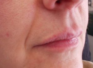 Dr. Kai Rezai Faltenbehandlung vorher