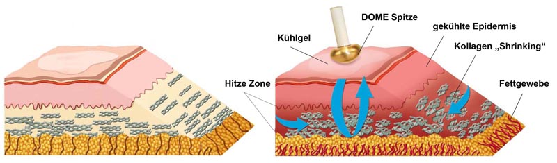 Pellevé / Radiage zur Faltenglättung