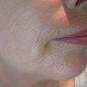 Pellevé / Radiage zur Faltenglättung