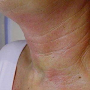 Pellevé / Radiage zur Faltenglättung