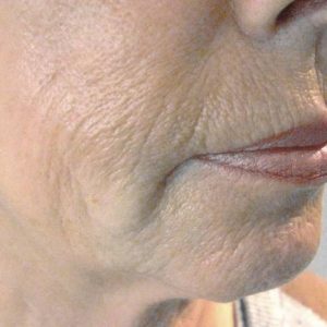 Pellevé / Radiage zur Faltenglättung