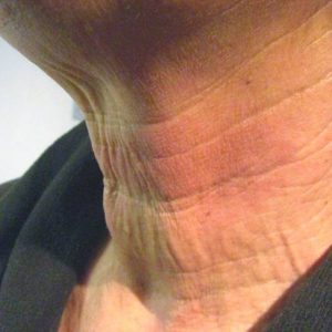 Pellevé / Radiage zur Faltenglättung