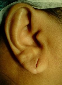 Ohrläppchenkorrektur