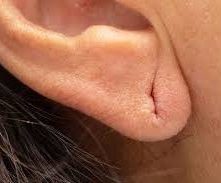 Ohrläppchenkorrektur