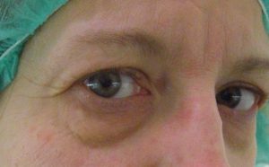 Tränensack Korrektur