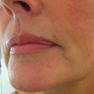 Lippen Aufspritzung vorher Dr. Kai Rezai 