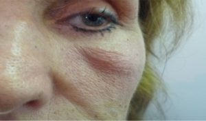 Malar Mounds vorher Dr. Kai Rezai Malar Mounds vorher Dr. Kai Rezai