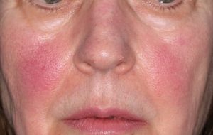 Rosacea - Laser Therapie