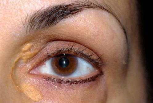 Xantelasmen Laser Dr. Kai Rezai