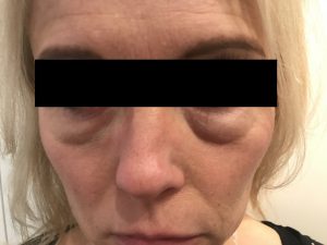 Unterlidschwellung nach Hyaluron Filler Anwendung Unterlidschwellung nach Hyaluron Filler Anwendung