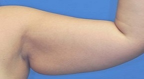 Oberarmstraffung - Brachioplastik