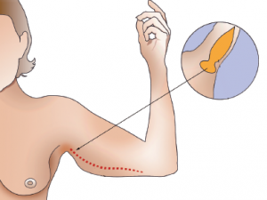 Oberarmstraffung Dr. Kai Rezai