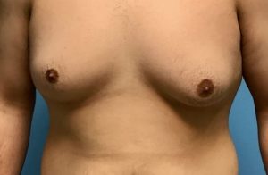 Gynäkomastie Behandlung